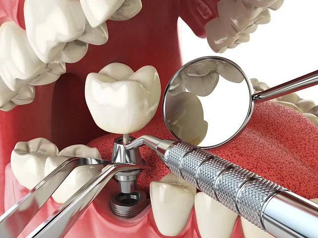 dental clinic implant treatments