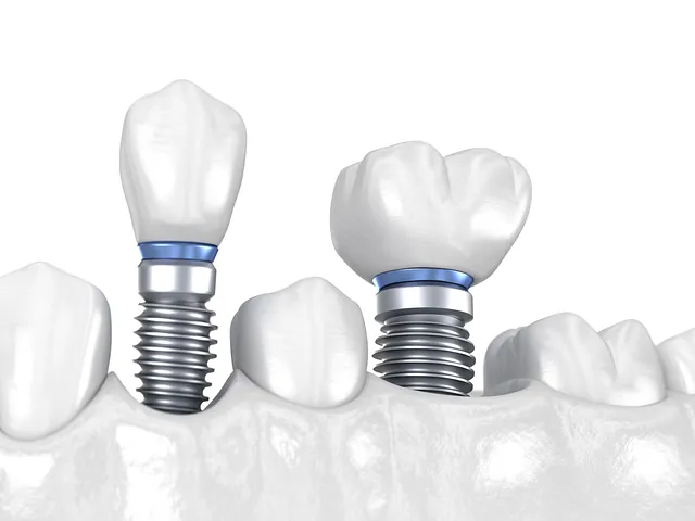 dental implants weston-super-mare clinic