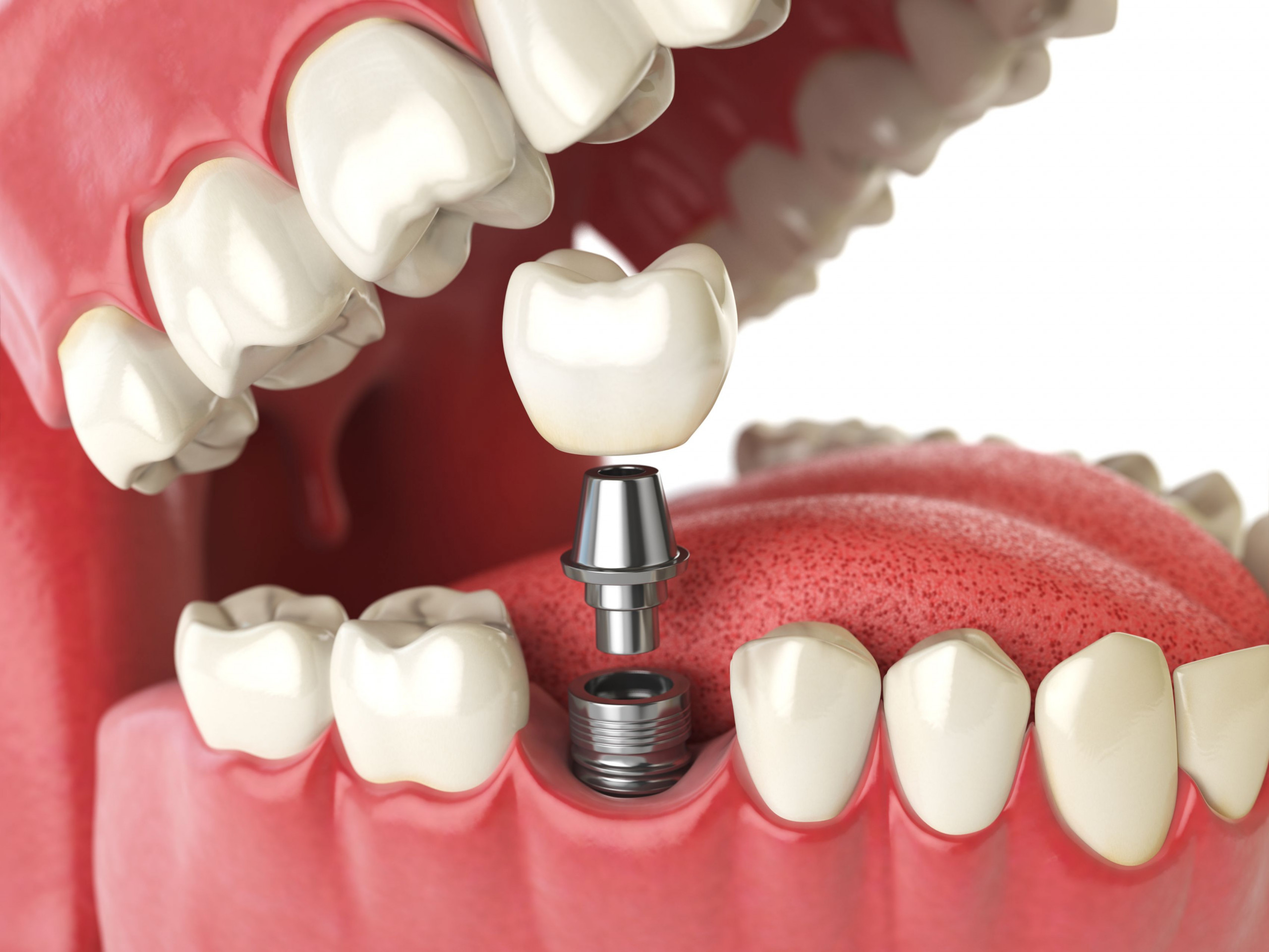 dental implants and treatment