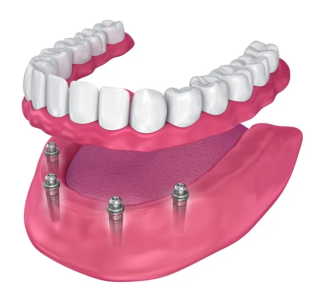 Implant-Retained Dentures