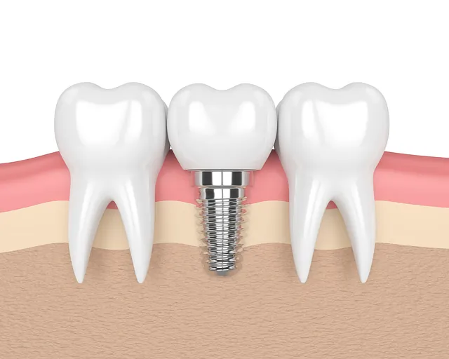  Cost of dental clinic implants